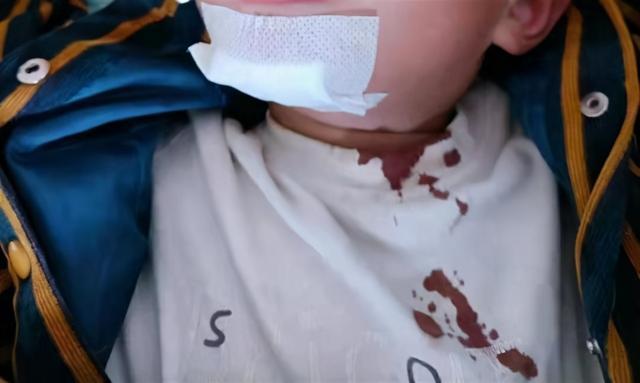 温州一男童幼儿园内摔伤，园方支付医疗费，却向家长加收生活费！